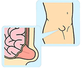 下腹部にぽこっと膨らみがあったら脱腸(鼠径ヘルニア)かも