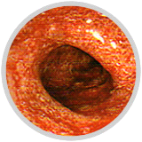 盲腸に出来る潰瘍；潰瘍性大腸炎とは