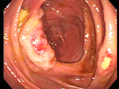 盲腸・直腸に出来る潰瘍；アメーバ赤痢（アメーバ症）とは