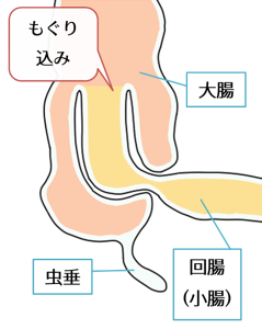 腸重積は放っておくと腸が腐る！？