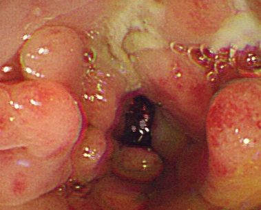 潰瘍性大腸炎の内視鏡所見：潰瘍と偽ポリープ