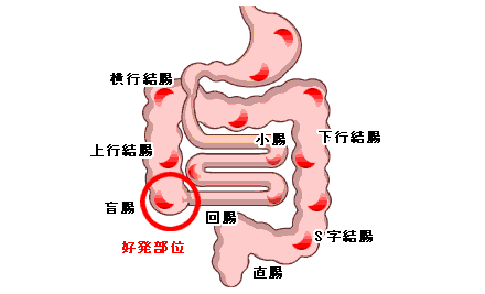 大腸にできる潰瘍；クローン病とは