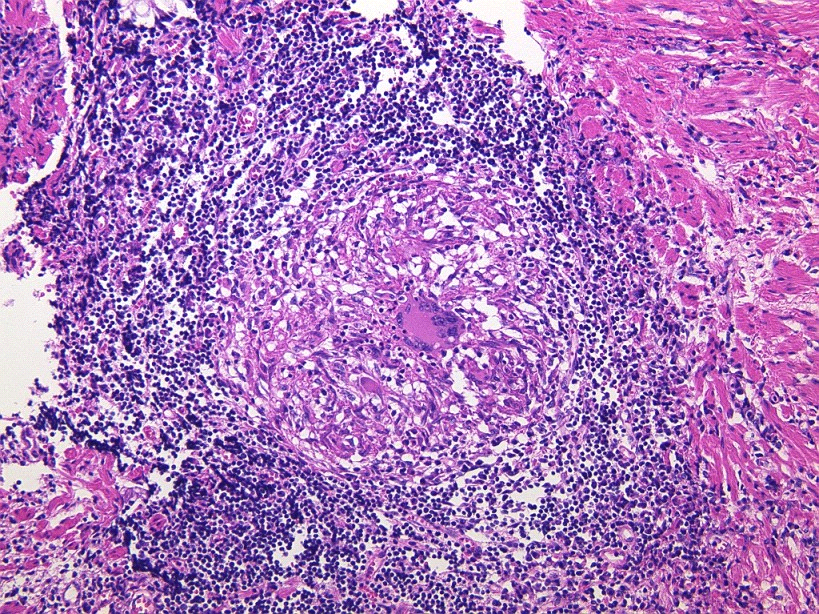 大腸にできる潰瘍；クローン病とは 横浜で大腸内視鏡による大腸検査なら、ららぽーと横浜クリニック