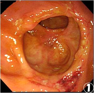 盲腸にできる潰瘍；腸結核とは