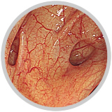 大腸憩室（けいしつ）からの出血