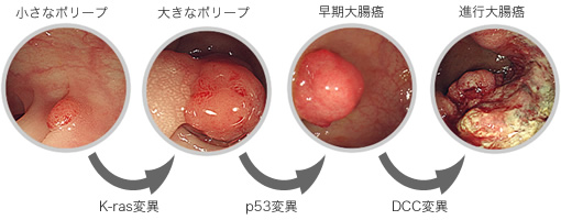 多段階発がんモデル