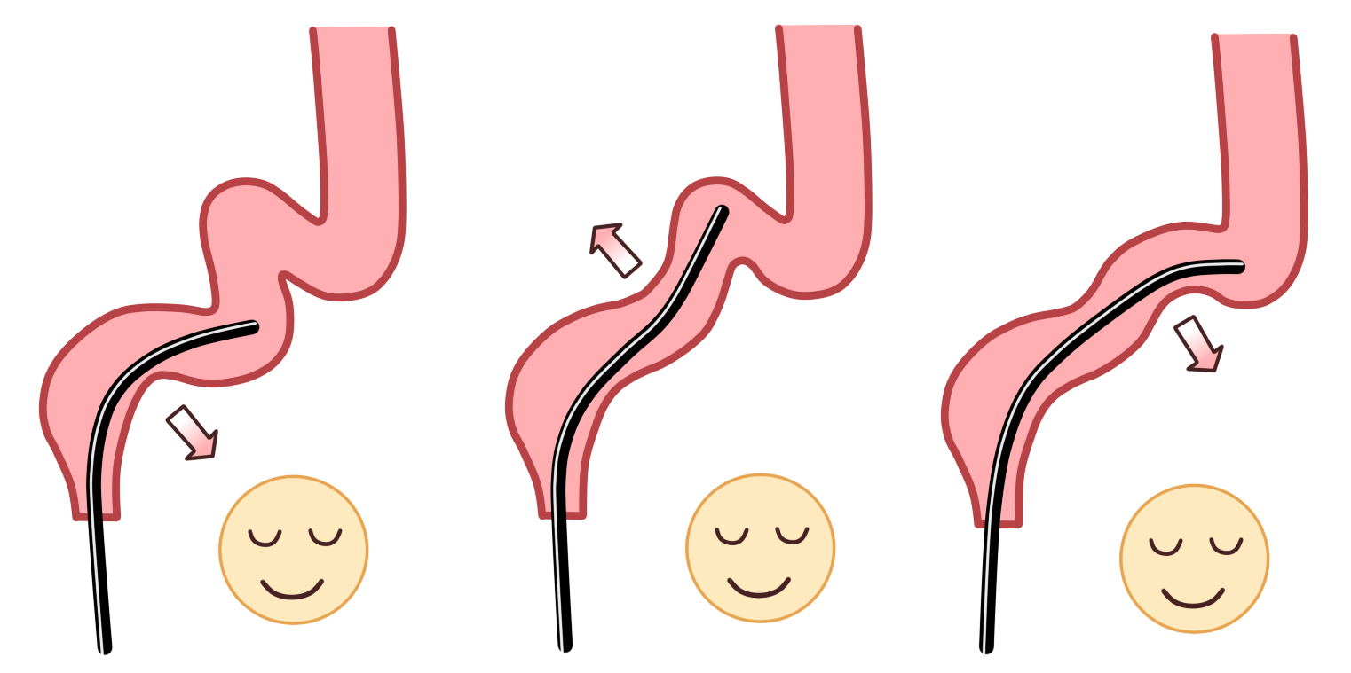 軸保持短縮法(無痛大腸内視鏡検査法)のメリット