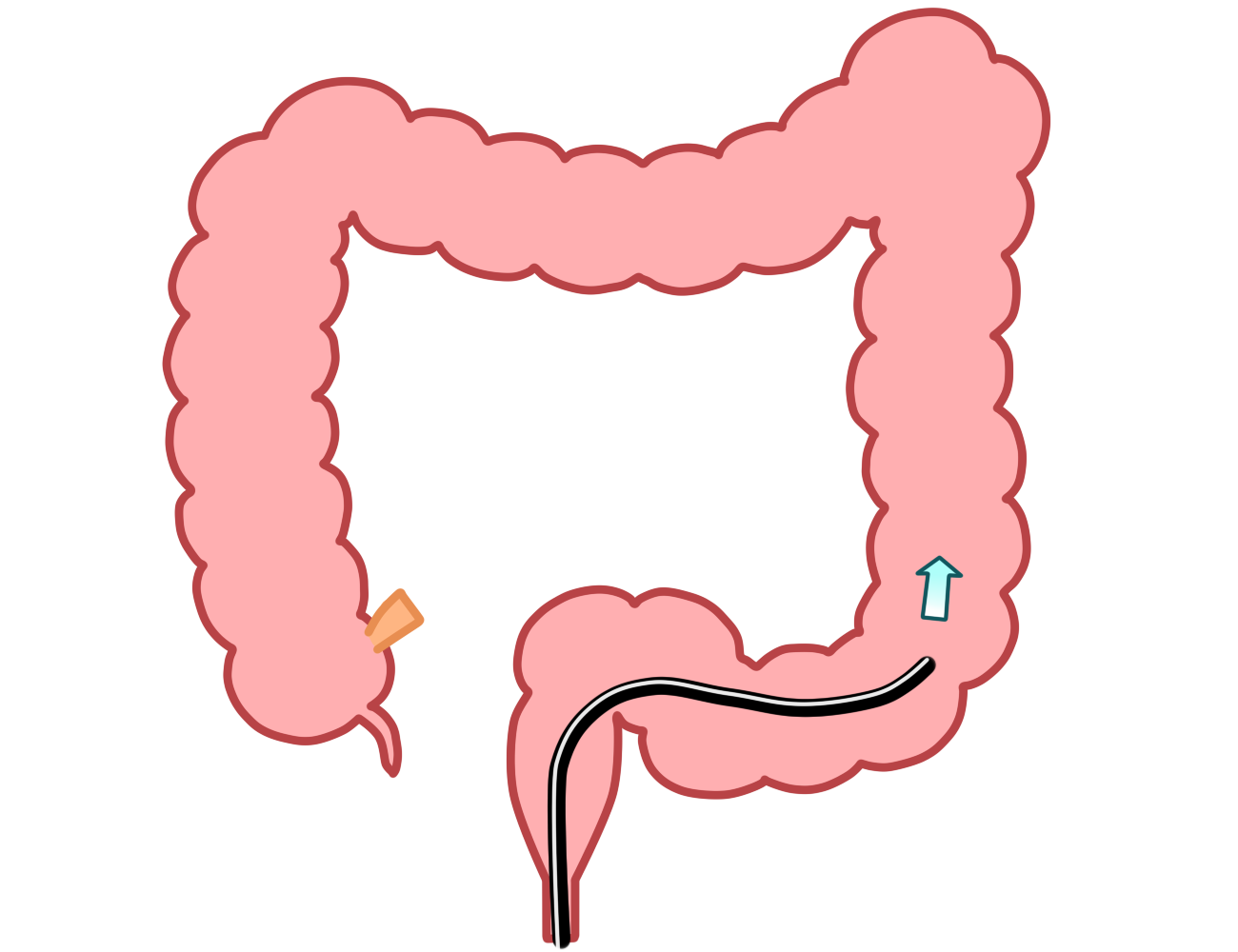 大腸内視鏡検査とは?01