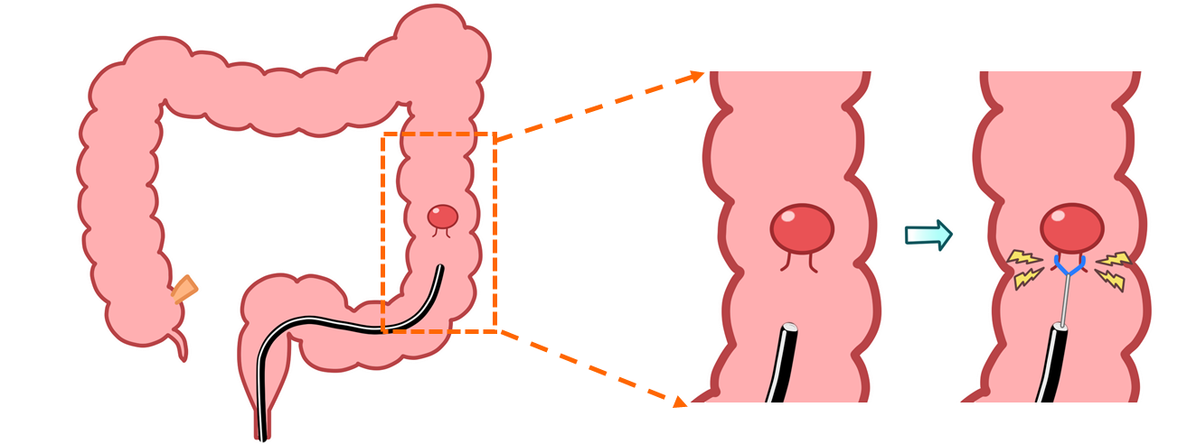 大腸内視鏡検査とは?04