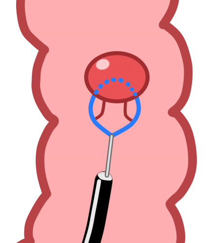 大腸ポリープの内視鏡的切除 横浜で大腸内視鏡による大腸検査なら ららぽーと横浜クリニック