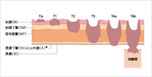 癌の深達度の図説