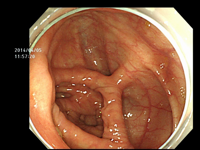正常な大腸粘膜の写真